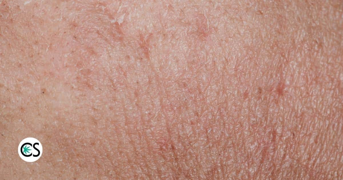 close up of extremely dry skin