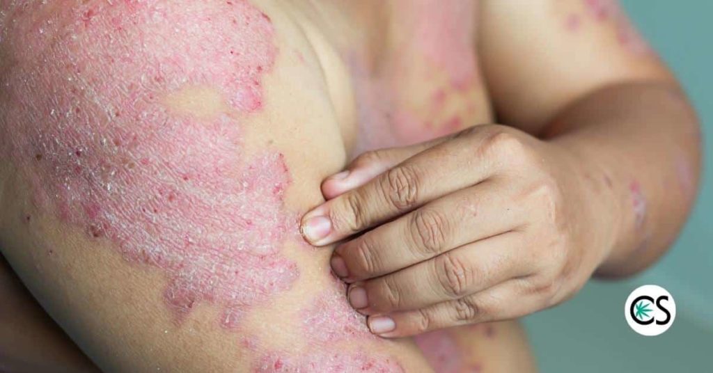 Man with psoriasis on his arm and chest