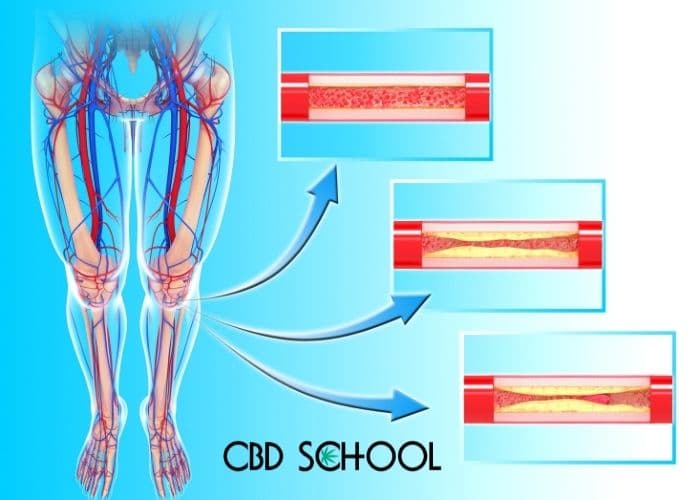 Atherosclerosis is the hardening of the blood vessels