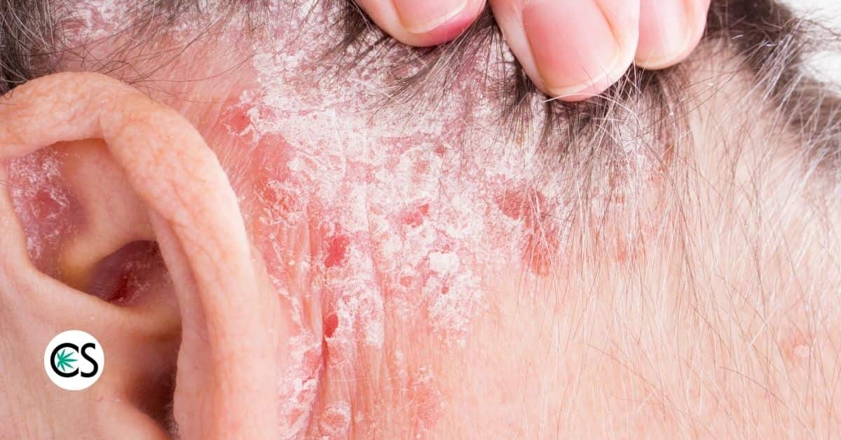 Man with bad psoriasis on his scalp
