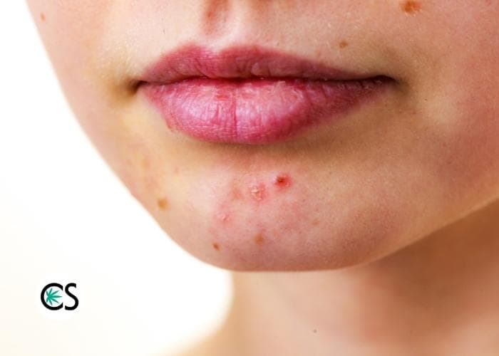 woman's chin with acne